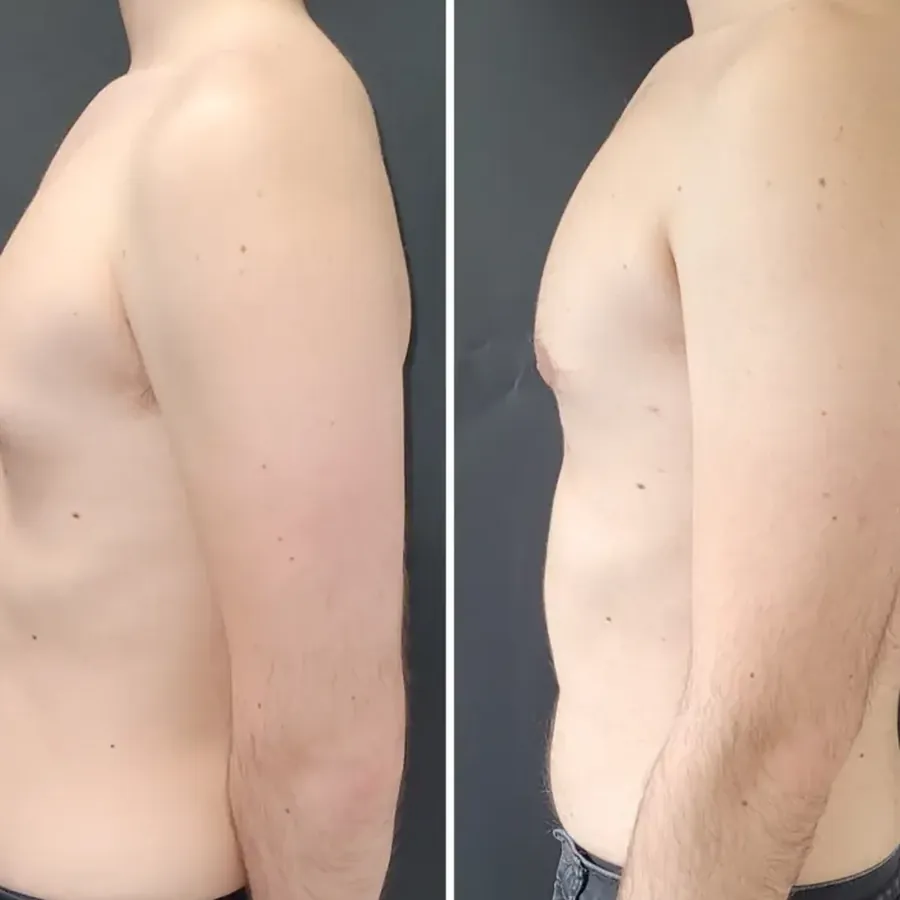 Avant/après Gynécomastie, résultat à 3 mois, Dr Nathanel Edery, Clinique Spontini Paris 16e (vue 1)