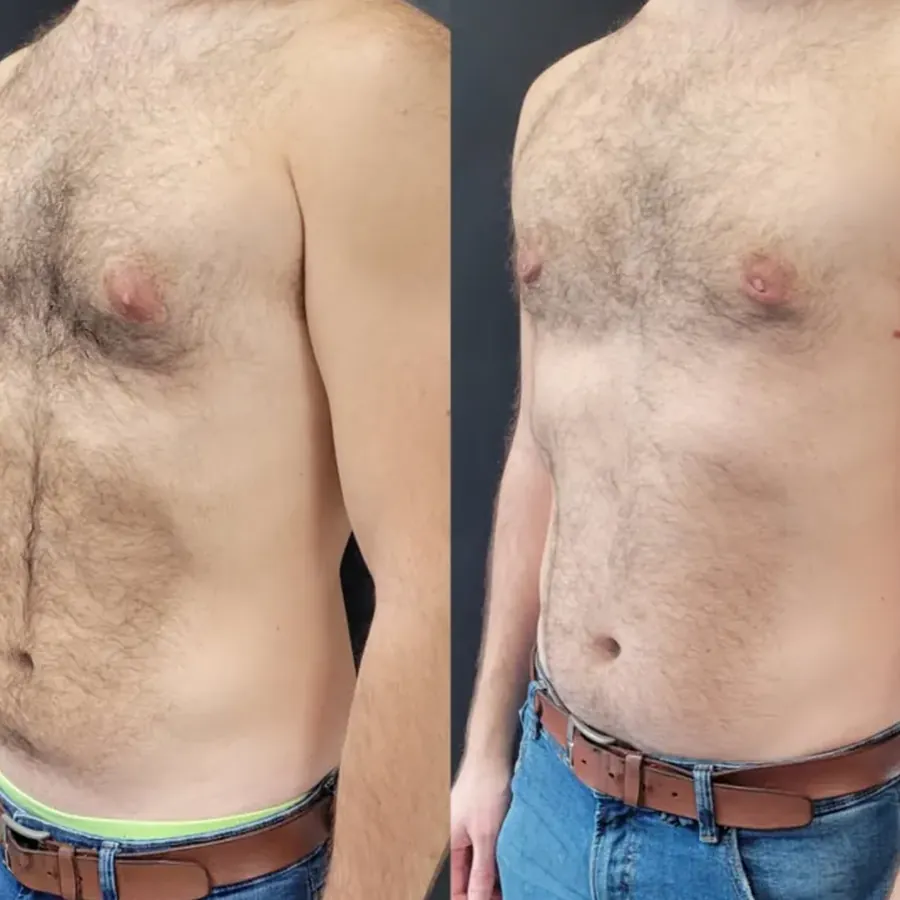 Avant/après Gynécomastie, résultat à 6 mois, Dr Nathanel Edery, Clinique Spontini Paris 16e (vue 1)