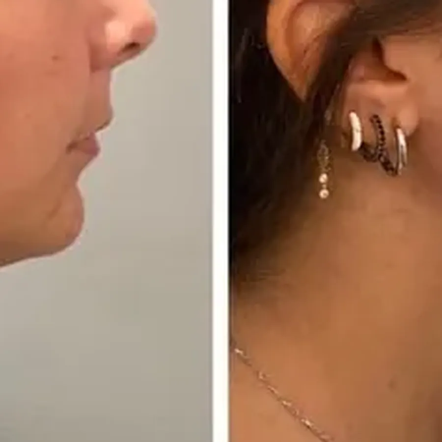 Avant/après Jawline contouring, patiente de 38 ans, Dr Daniel Alimi, Clinique Spontini Paris 16e (vue 1)