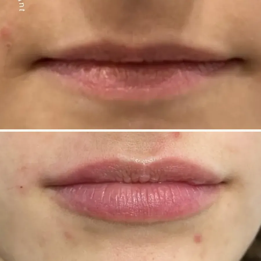 Avant/après Lèvres, 1 ml d'acide hyaluronique, Dr Daniel Alimi, Clinique Spontini Paris 16e