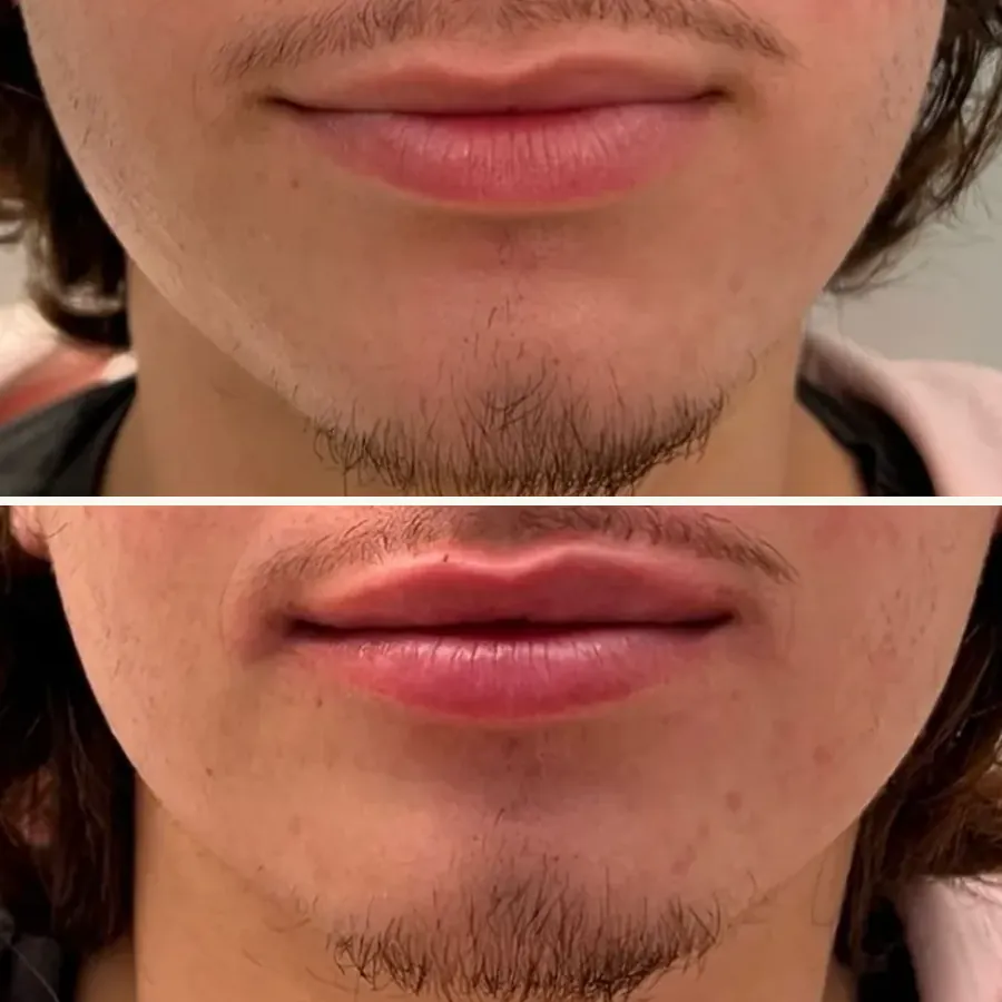 Avant/après Lèvres chez l’homme (asymétrie), Dr Daniel Alimi, Clinique Spontini Paris 16e