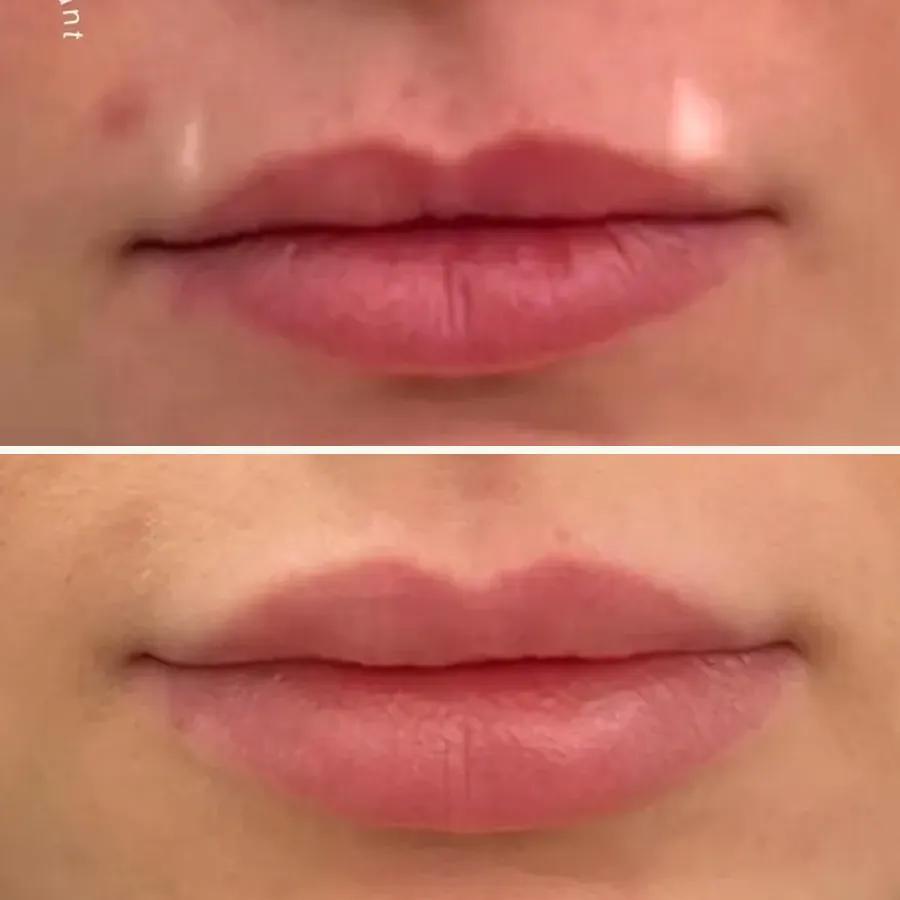 Avant/après Lèvres naturelles, Dr Daniel Alimi, Clinique Spontini Paris 16e