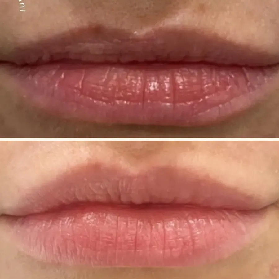 Avant/après Lèvres naturelles, Dr Daniel Alimi, Clinique Spontini Paris 16e