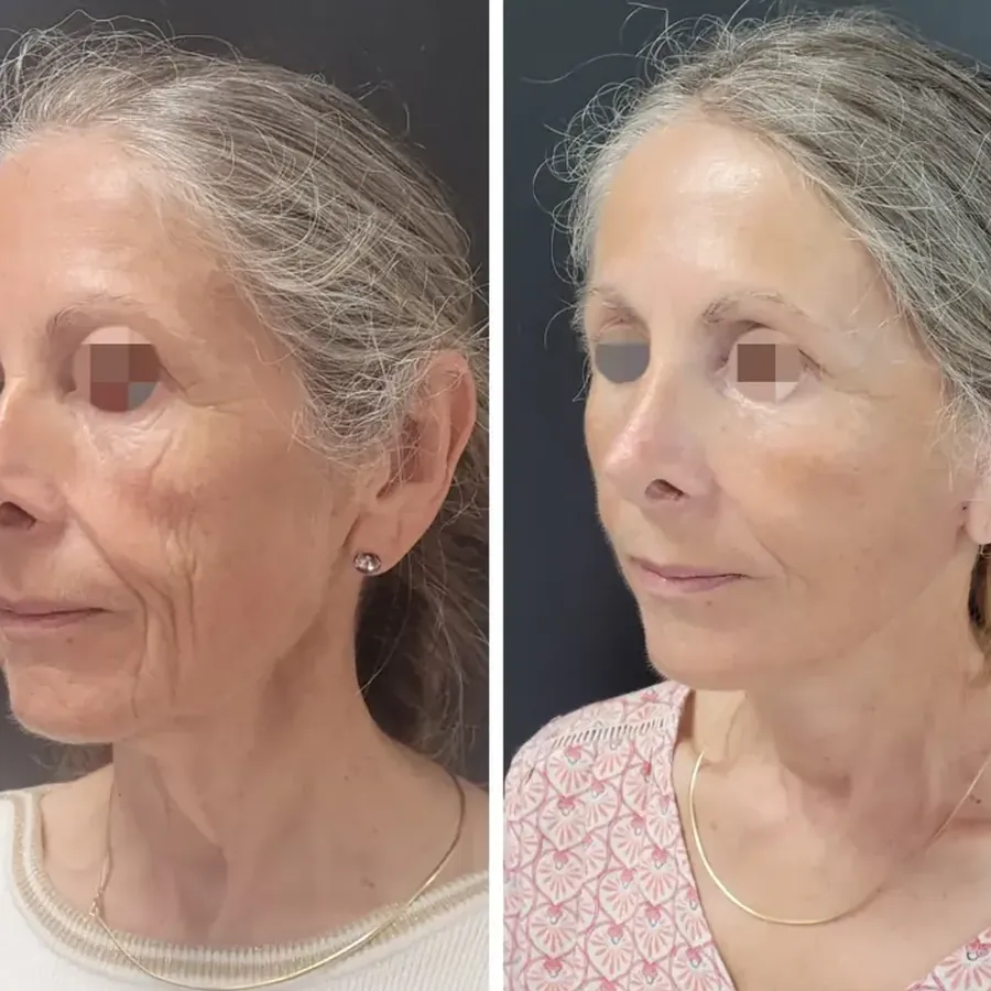 Avant/après Lifting cervico-jugal, résultat à 3 mois, Dr Nathanel Edery, Clinique Spontini Paris 16e (vue 1)