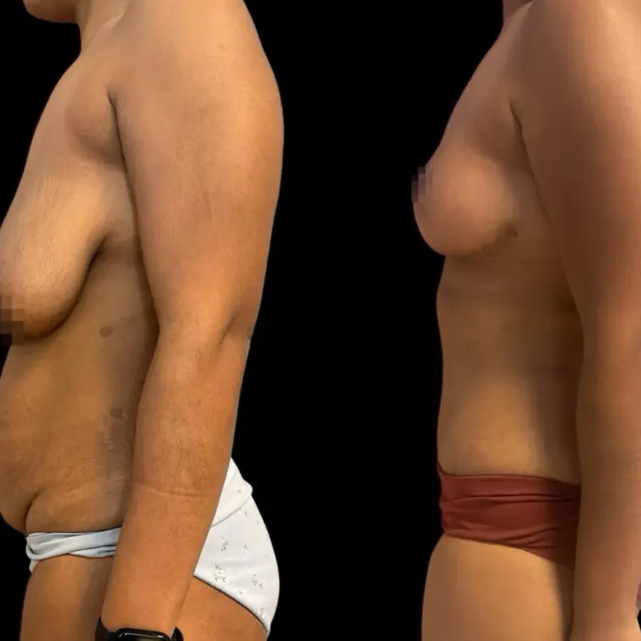 Avant/après Lifting mammaire (mastopexie), Dr Nathanel Edery, Clinique Spontini Paris 16e