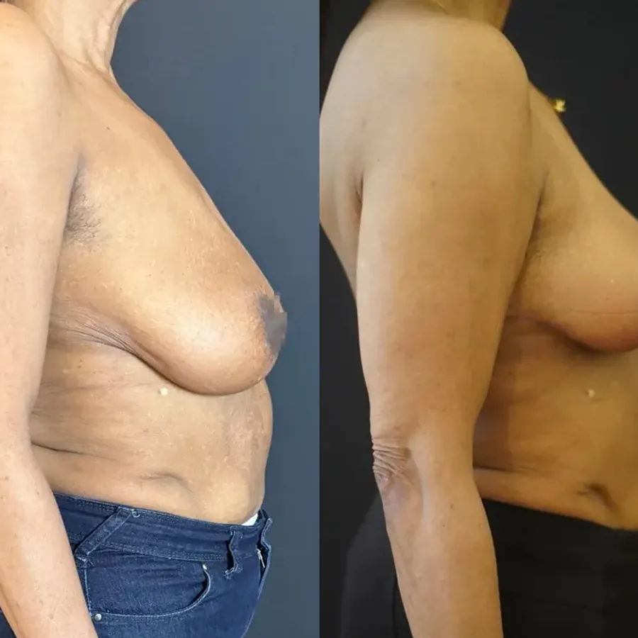 Avant/après Lifting mammaire (mastopexie), Dr Nathanel Edery, Clinique Spontini Paris 16e
