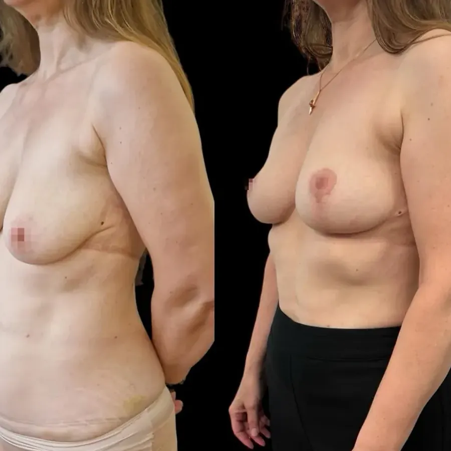 Avant/après Lifting mammaire (mastopexie), Dr Nathanel Edery, Clinique Spontini Paris 16e