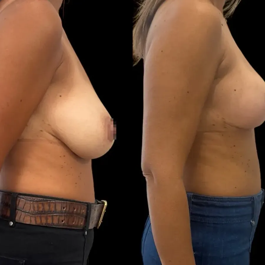Avant/après Lifting mammaire (mastopexie), Dr Nathanel Edery, Clinique Spontini Paris 16e