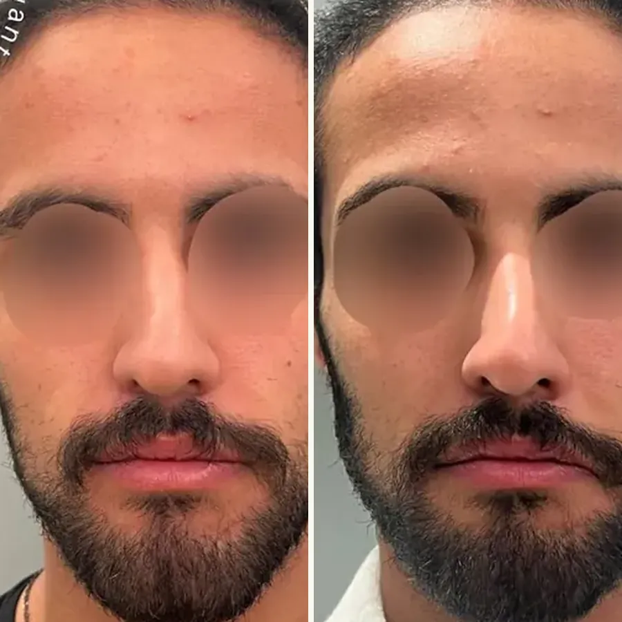Avant/après Masculinisation (angles mandibulaires), Dr Daniel Alimi, Clinique Spontini Paris 16e