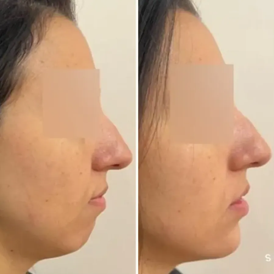 Avant/après Menton fuyant traité sans chirurgie, Dr Daniel Alimi, Clinique Spontini Paris 16e (vue 1)