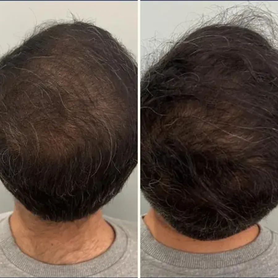 Avant/après Mésothérapie capillaire, résultat à 6 mois, Dr Daniel Alimi, Clinique Spontini Paris 16e