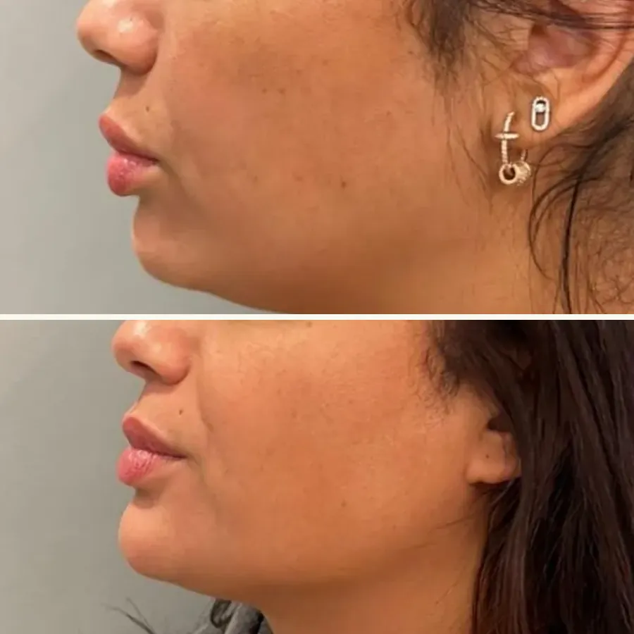 Avant/après Ovale du visage et menton, Dr Daniel Alimi, Clinique Spontini Paris 16e