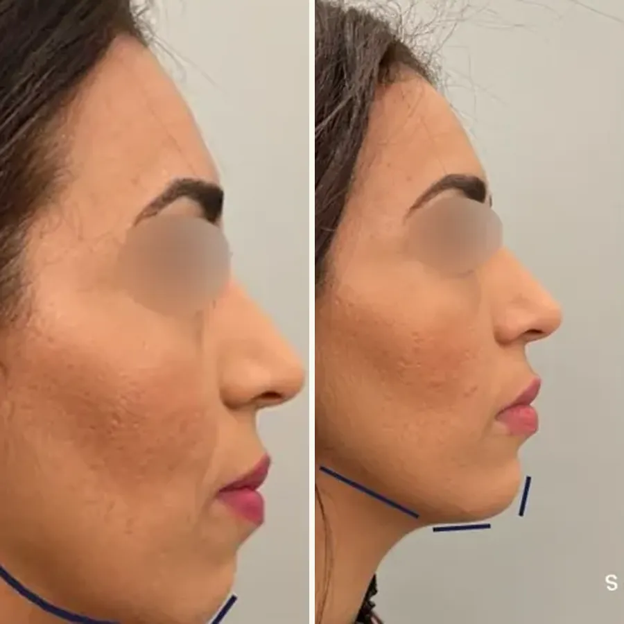 Avant/après Ovale redessiné par injections, Dr Daniel Alimi, Clinique Spontini Paris 16e