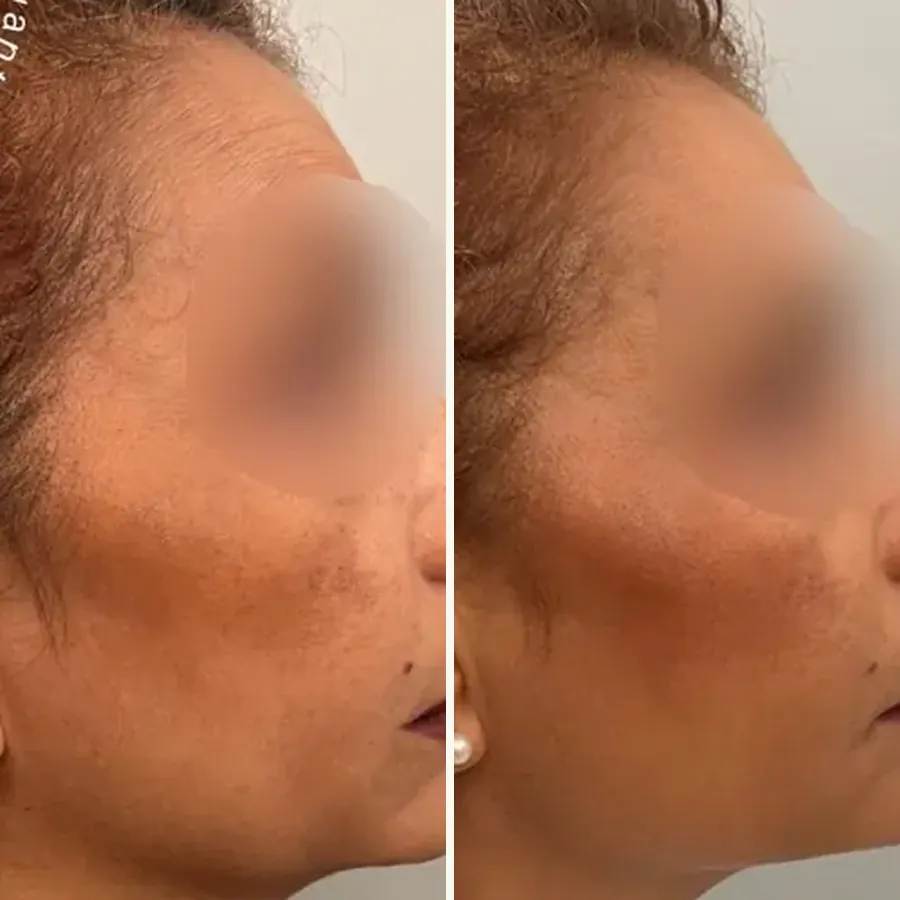 Avant/après Perte de définition de l’ovale, Dr Daniel Alimi, Clinique Spontini Paris 16e