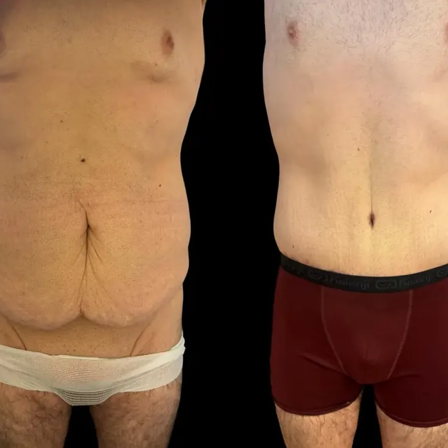 Avant/après Plastie abdominale après perte de 65 kg, 4 mois, Dr Nathanel Edery, Clinique Spontini Paris 16e (vue 1)