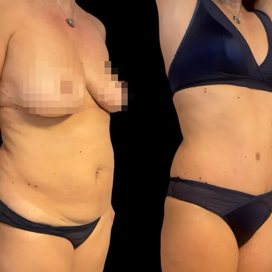 Avant/après Plastie abdominale, Dr Nathanel Edery, Clinique Spontini Paris 16e
