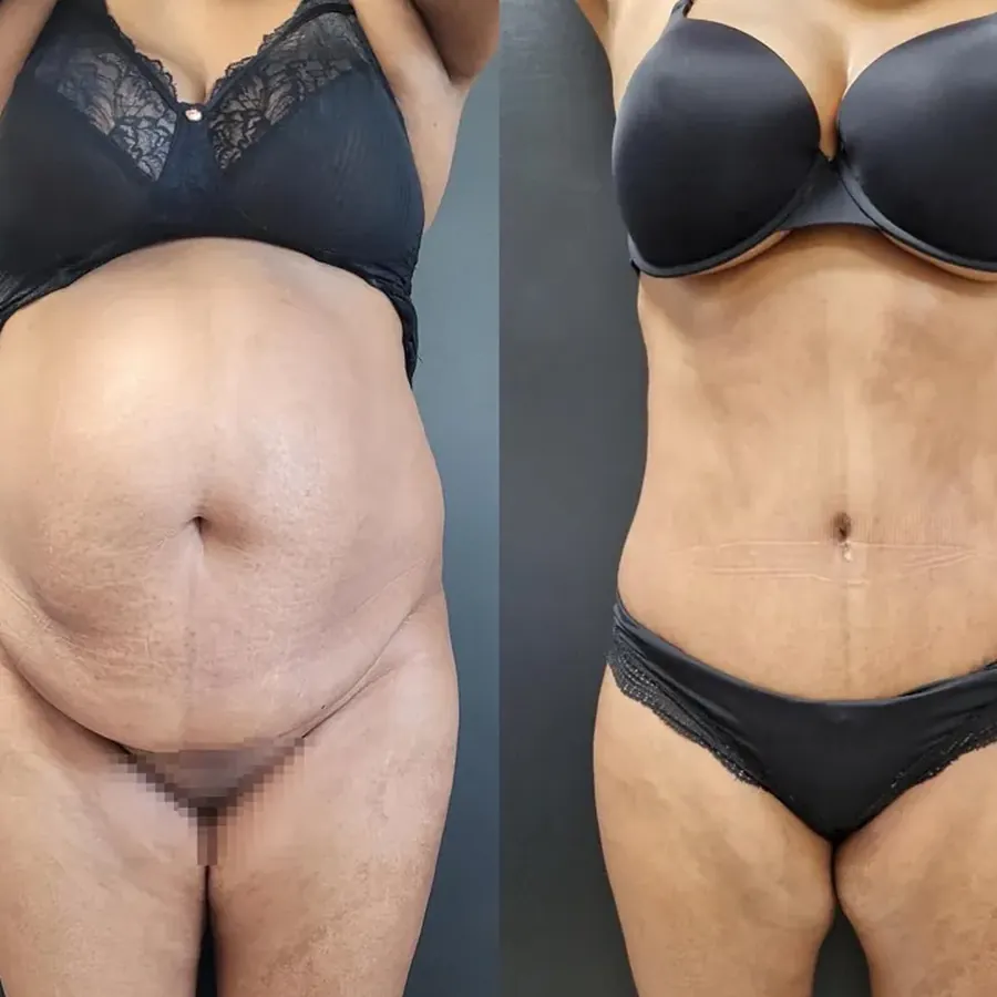 Avant/après Plastie abdominale et diastasis, résultat à 1 an, Dr Nathanel Edery, Clinique Spontini Paris 16e (vue 1)
