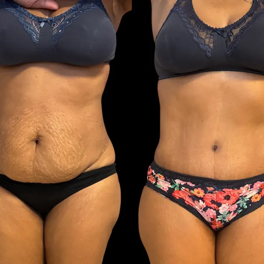 Avant/après Plastie abdominale haute tension + diastasis, 6 mois, Dr Nathanel Edery, Clinique Spontini Paris 16e (vue 1)