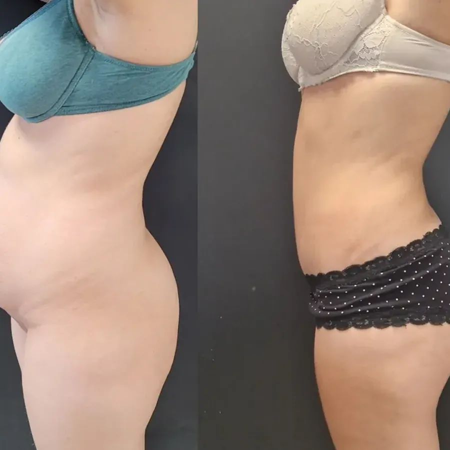 Avant/après Plastie abdominale + muscles resserrés (diastasis), 9 mois, Dr Nathanel Edery, Clinique Spontini Paris 16e (vue 1)