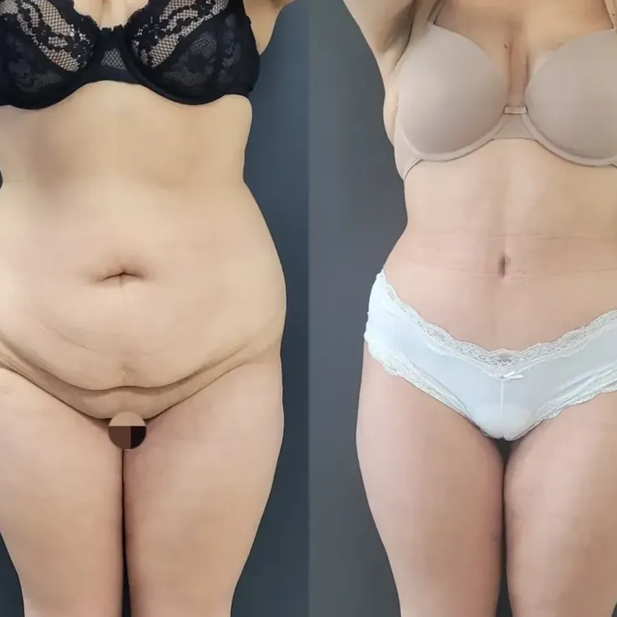 Avant/après Plastie abdominale, résultat à 1 an, Dr Nathanel Edery, Clinique Spontini Paris 16e (vue 1)