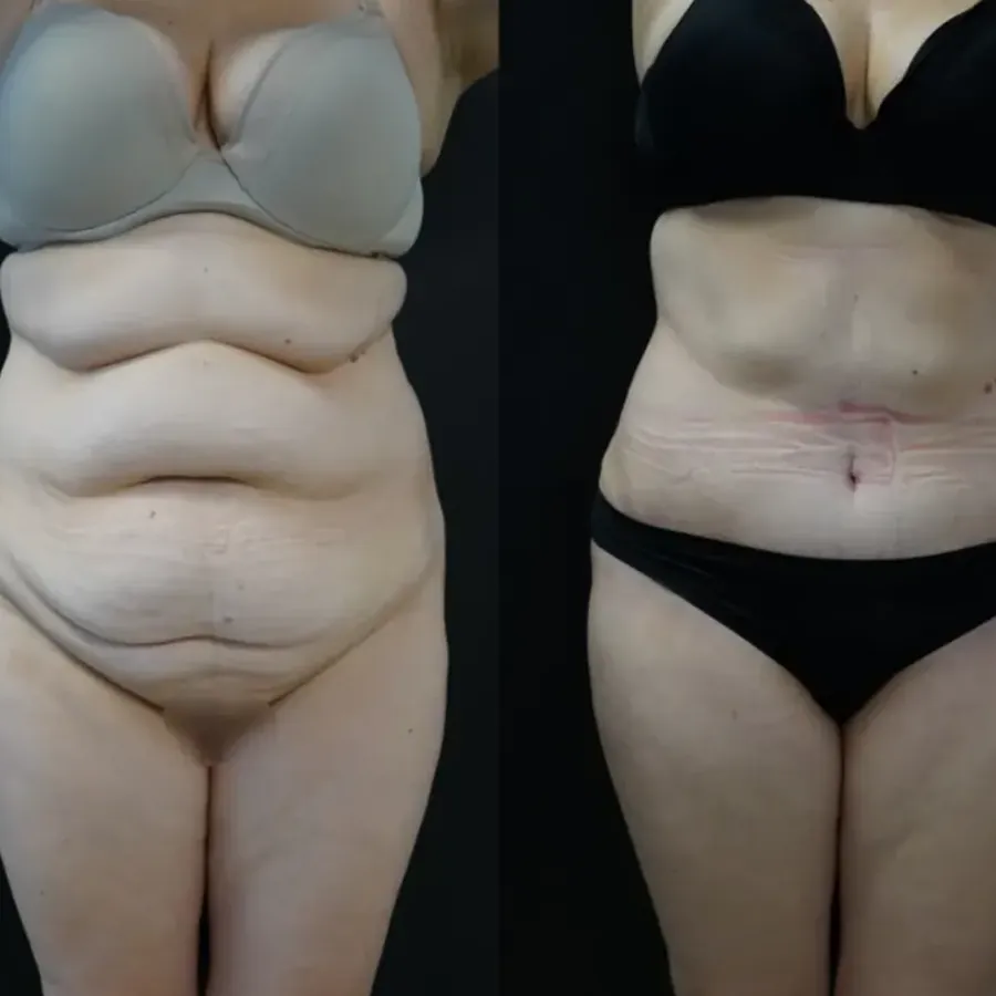 Avant/après Plastie abdominale (tablier, bourrelets), Dr Nathanel Edery, Clinique Spontini Paris 16e (vue 1)