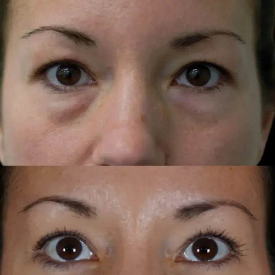 Avant/après Poches sous les yeux, Dr Nathanel Edery, Clinique Spontini Paris 16e (vue 1)