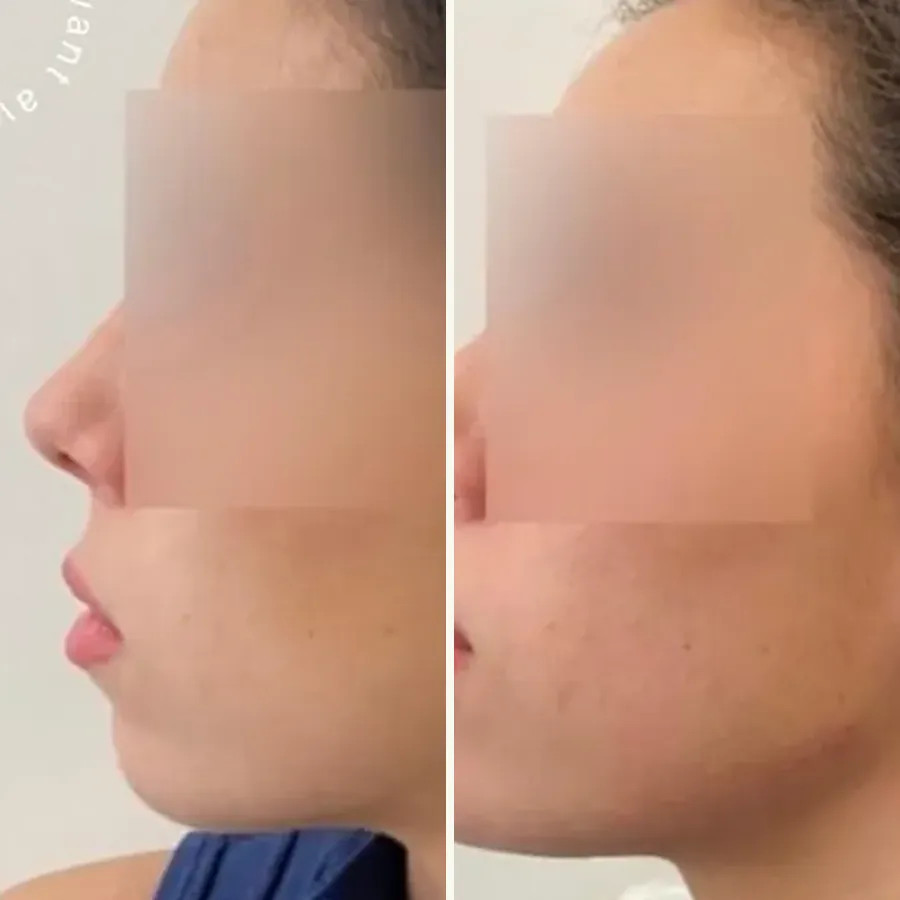 Avant/après Profiloplastie (ligne de Ricketts), Dr Daniel Alimi, Clinique Spontini Paris 16e