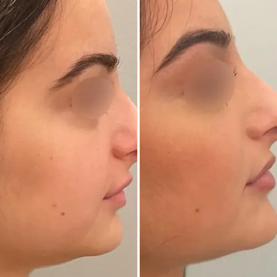 Avant/après Profiloplastie (nez + menton), Dr Daniel Alimi, Clinique Spontini Paris 16e