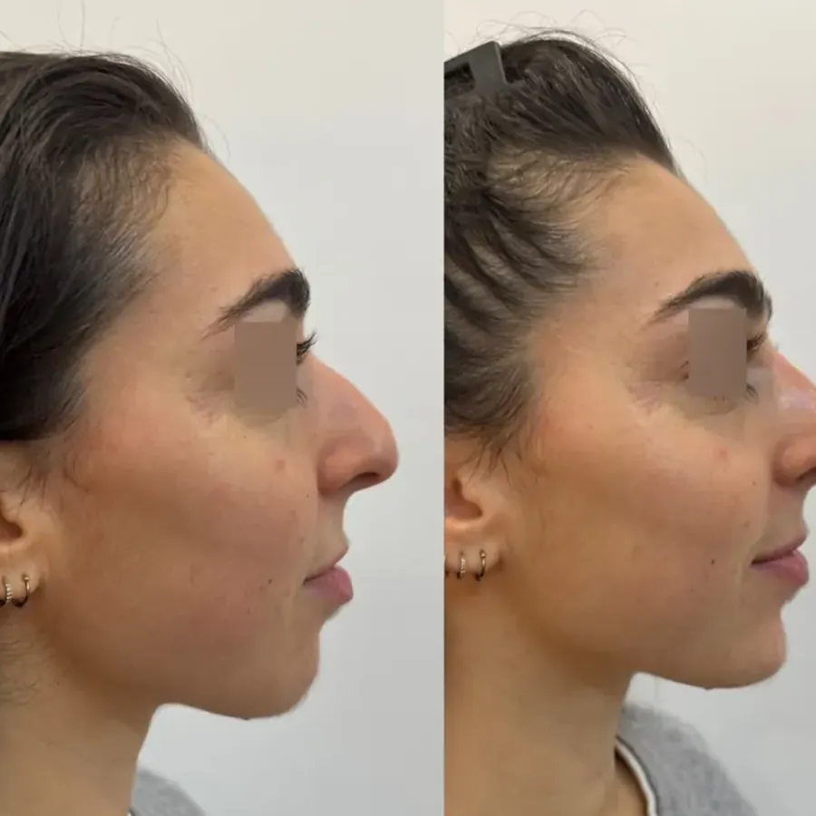 Avant/après Profiloplastie : rhinoplastie et génioplastie médicales, Dr Daniel Alimi, Clinique Spontini Paris 16e