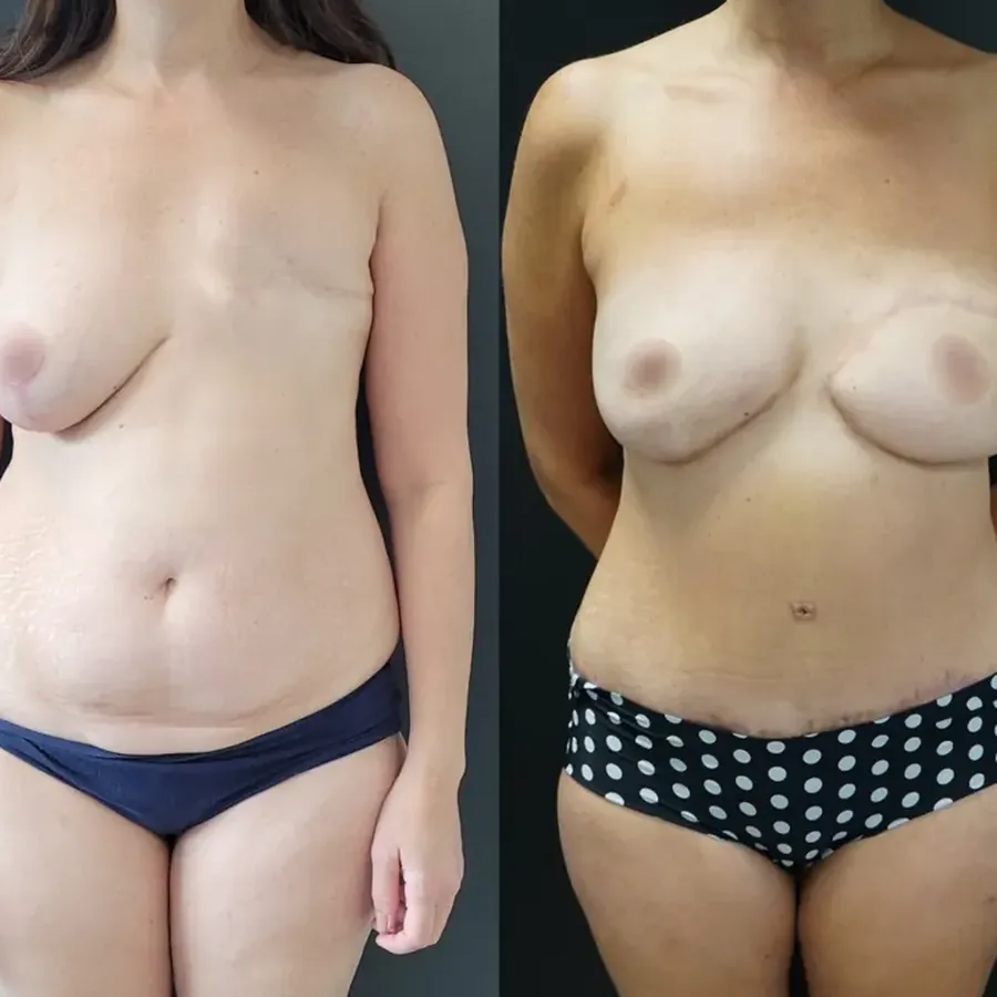 Avant/après Reconstruction mammaire après mastectomie (mutation BRCA), Dr Nathanel Edery, Clinique Spontini Paris 16e (vue 1)