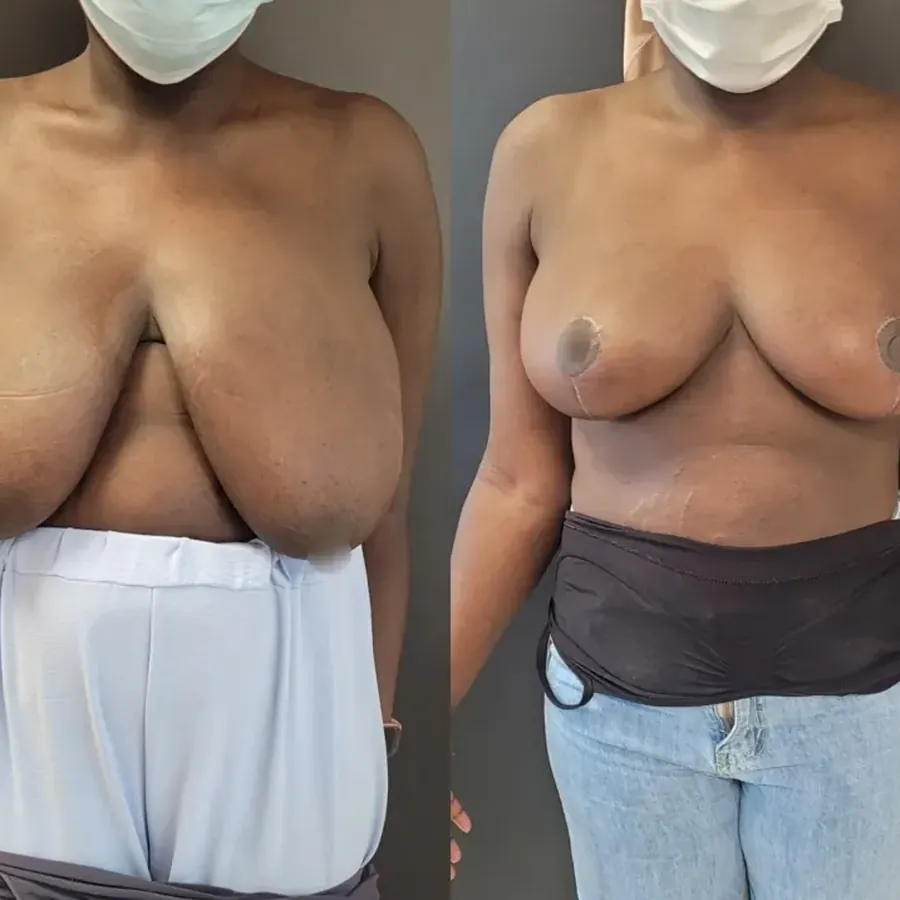 Avant/après Réduction mammaire, Dr Nathanel Edery, Clinique Spontini Paris 16e