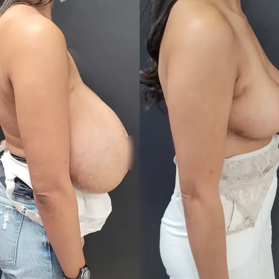 Avant/après Réduction mammaire, Dr Nathanel Edery, Clinique Spontini Paris 16e