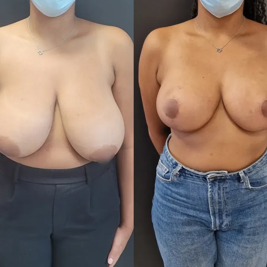 Avant/après Réduction mammaire, Dr Nathanel Edery, Clinique Spontini Paris 16e
