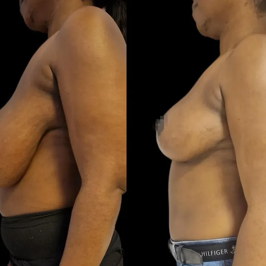 Avant/après Réduction mammaire, Dr Nathanel Edery, Clinique Spontini Paris 16e
