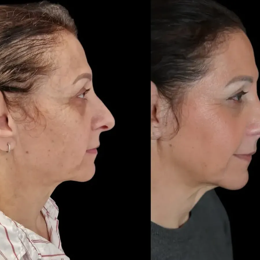Avant/après Rhinoplastie de préservation, Dr Nathanel Edery, Clinique Spontini Paris 16e (vue 1)