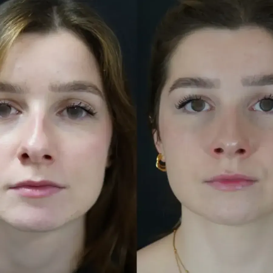 Avant/après Rhinoplastie de préservation (push down), résultat à 3 mois, Dr Nathanel Edery, Clinique Spontini Paris 16e (vue 1)