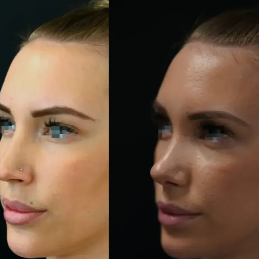 Avant/après Rhinoplastie de préservation, résultat à 2 mois, Dr Nathanel Edery, Clinique Spontini Paris 16e (vue 1)