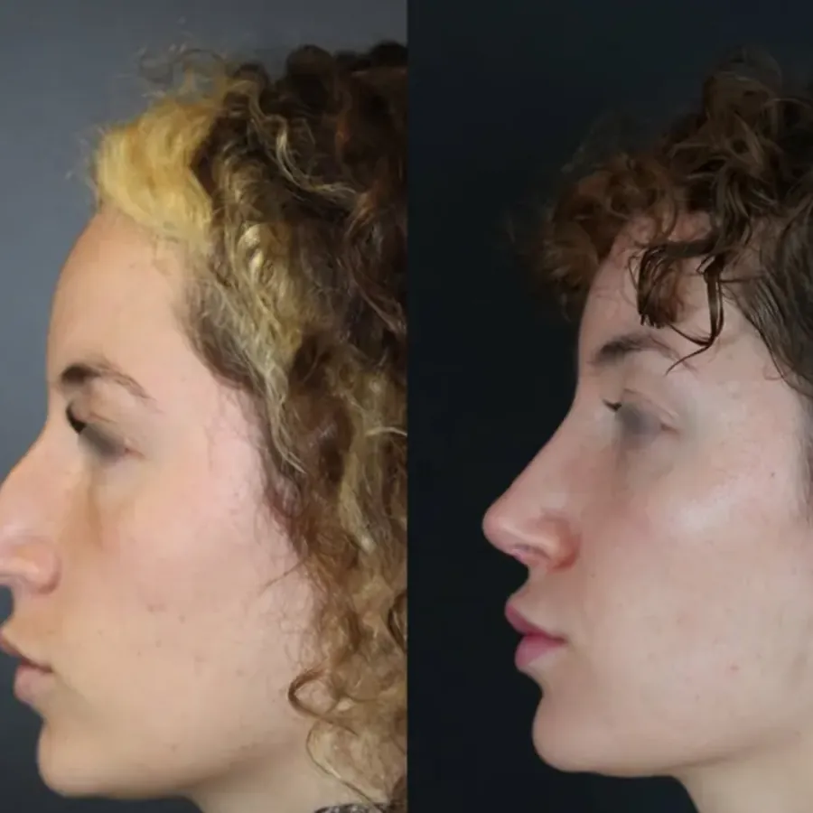 Avant/après Rhinoplastie de préservation, résultat à 3 mois, Dr Nathanel Edery, Clinique Spontini Paris 16e (vue 1)