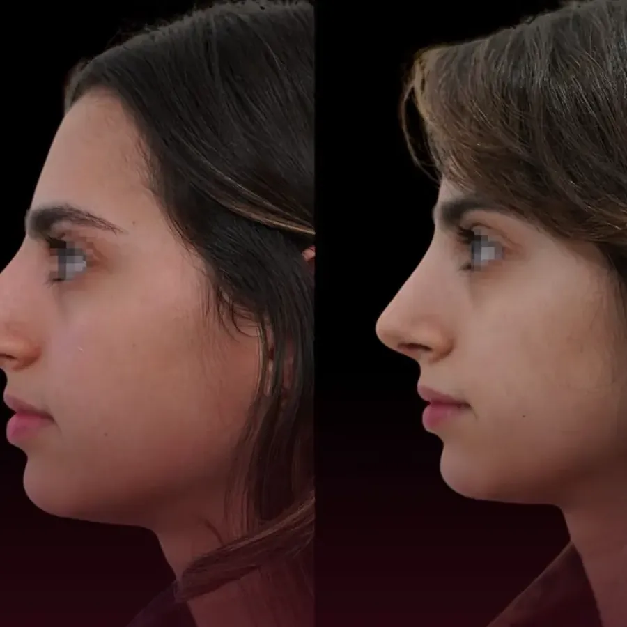 Avant/après Rhinoplastie de préservation, résultat à 3 mois, Dr Nathanel Edery, Clinique Spontini Paris 16e (vue 1)