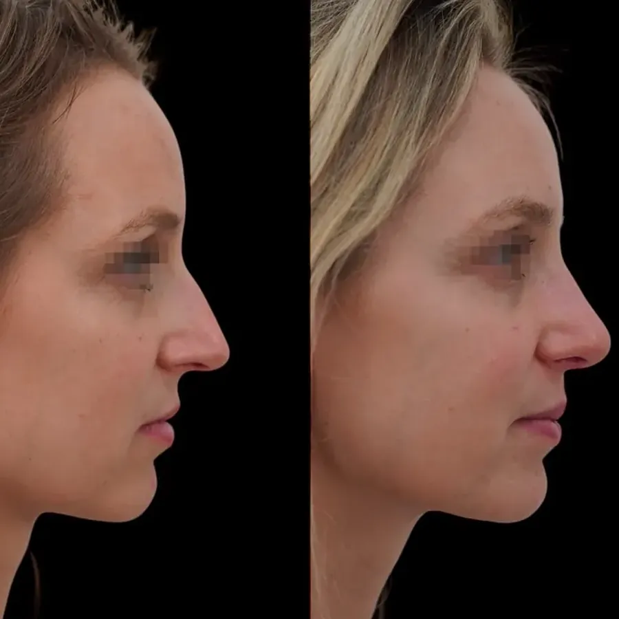 Avant/après Rhinoplastie de préservation, résultat à 6 mois, Dr Nathanel Edery, Clinique Spontini Paris 16e (vue 1)