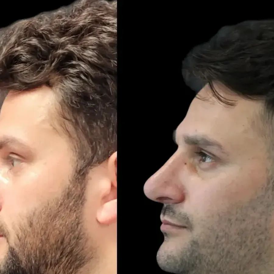 Avant/après Rhinoplastie masculine, Dr Nathanel Edery, Clinique Spontini Paris 16e (vue 1)
