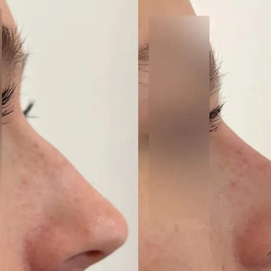 Avant/après Rhinoplastie médicale, à 15 jours, Dr Daniel Alimi, Clinique Spontini Paris 16e