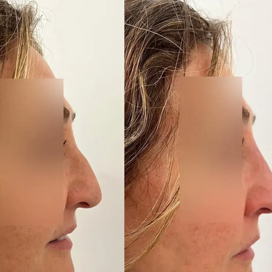 Avant/après Rhinoplastie médicale : arête et pointe, Dr Daniel Alimi, Clinique Spontini Paris 16e