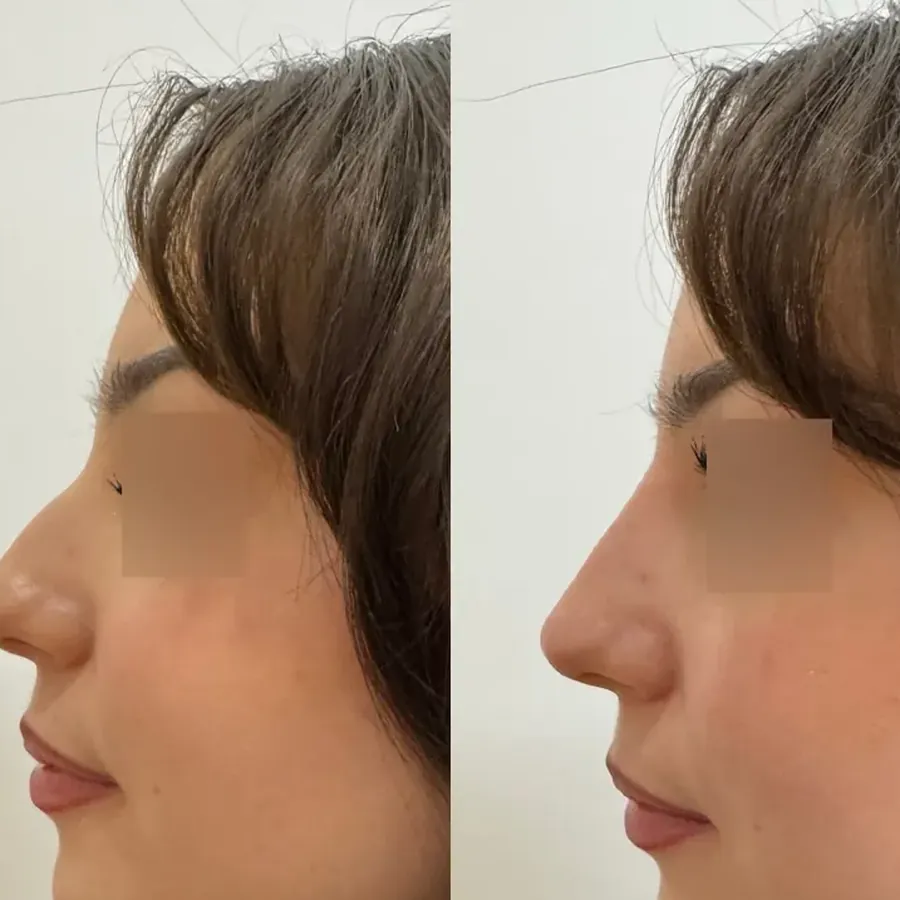 Avant/après Rhinoplastie médicale (aspect bosselé), Dr Daniel Alimi, Clinique Spontini Paris 16e