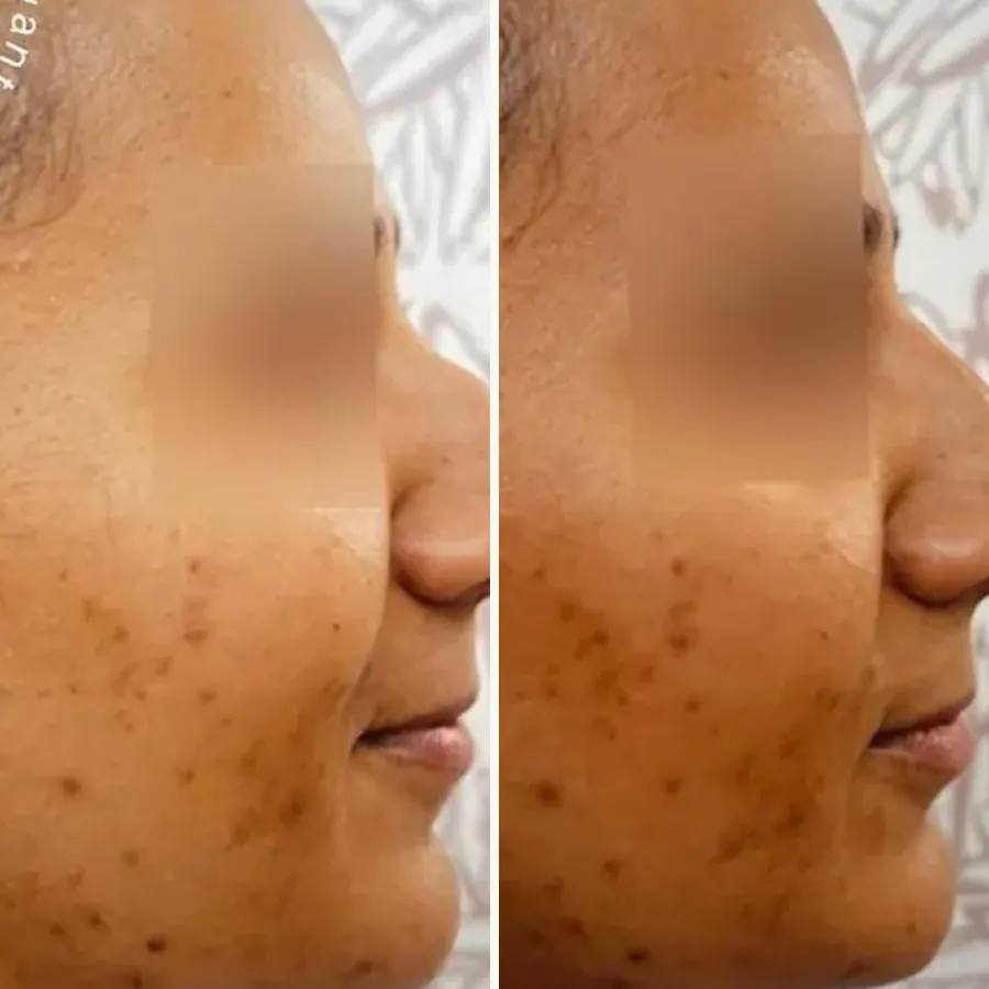 Avant/après Rhinoplastie médicale (bosse), à 15 jours, Dr Daniel Alimi, Clinique Spontini Paris 16e