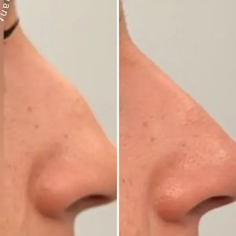 Avant/après Rhinoplastie médicale, Dr Daniel Alimi, Clinique Spontini Paris 16e