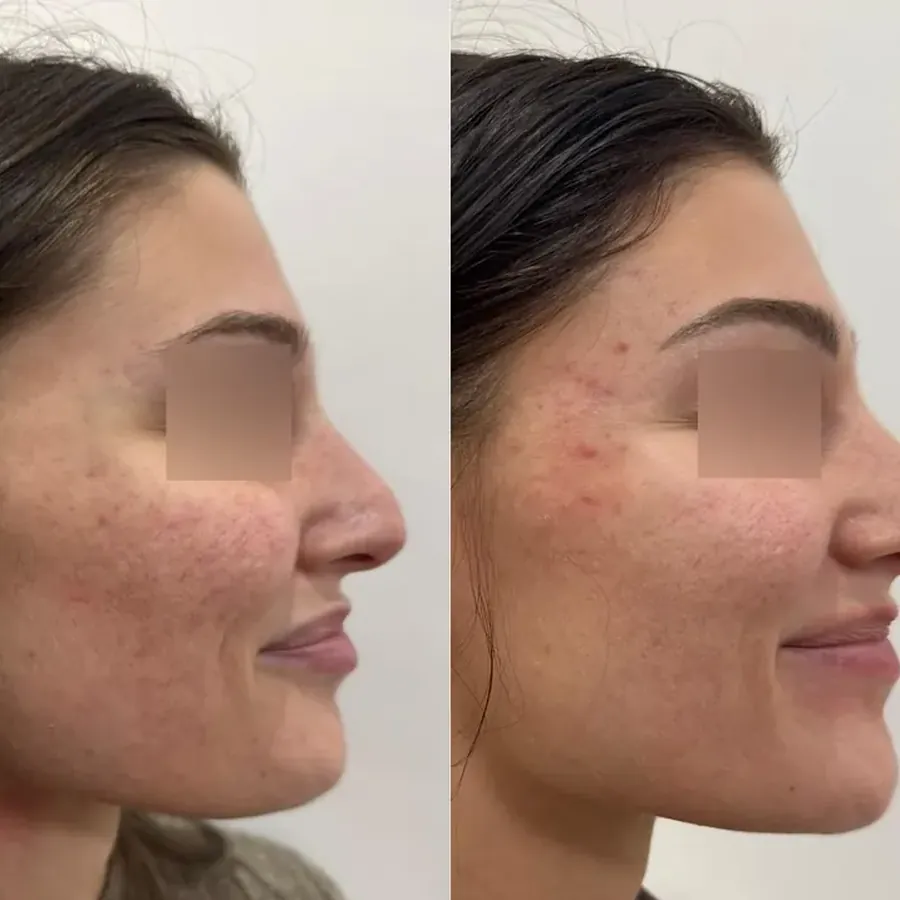Avant/après Rhinoplastie médicale, Dr Daniel Alimi, Clinique Spontini Paris 16e