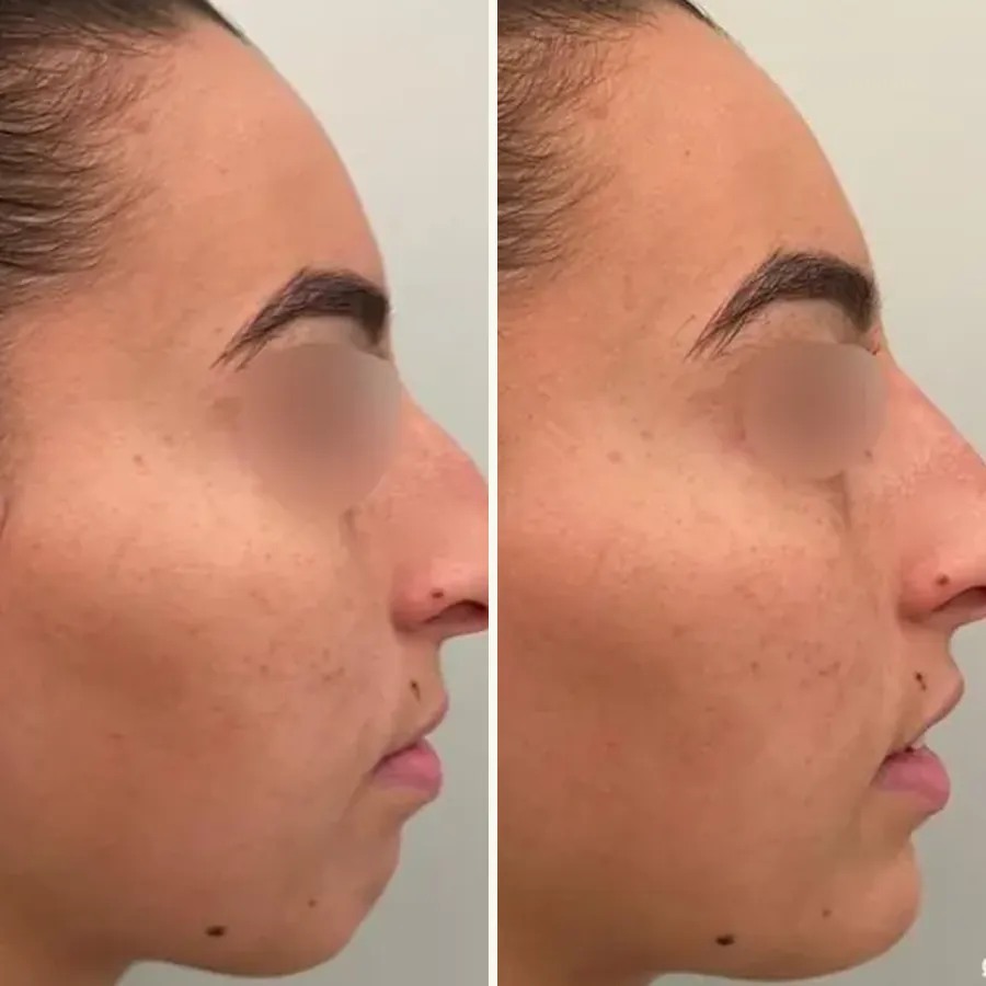 Avant/après Rhinoplastie médicale + génioplastie, Dr Daniel Alimi, Clinique Spontini Paris 16e (vue 1)