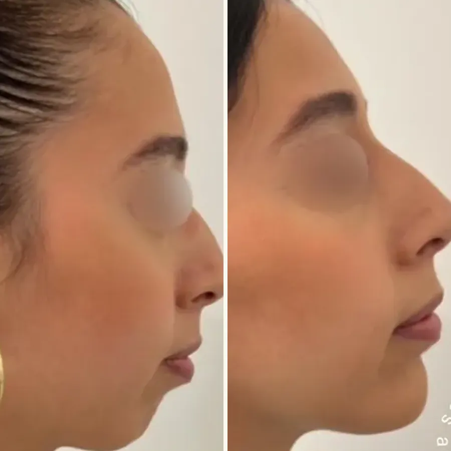 Avant/après Rhinoplastie médicale + génioplastie, Dr Daniel Alimi, Clinique Spontini Paris 16e (vue 1)