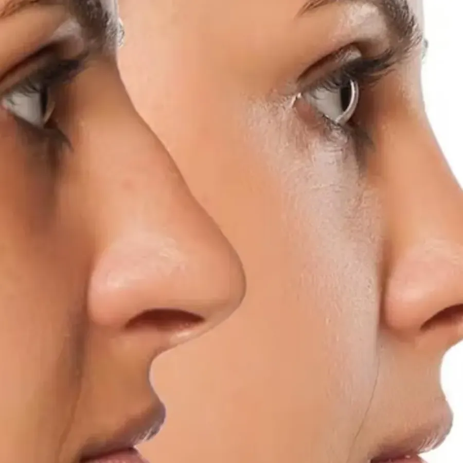 Avant/après Rhinoplastie médicale (irrégularités), Dr Daniel Alimi, Clinique Spontini Paris 16e